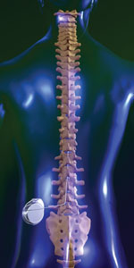 Implant l