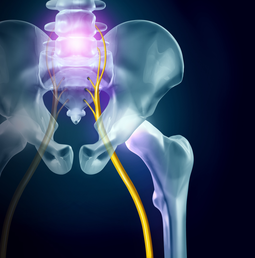 sciatica pain in the hips
