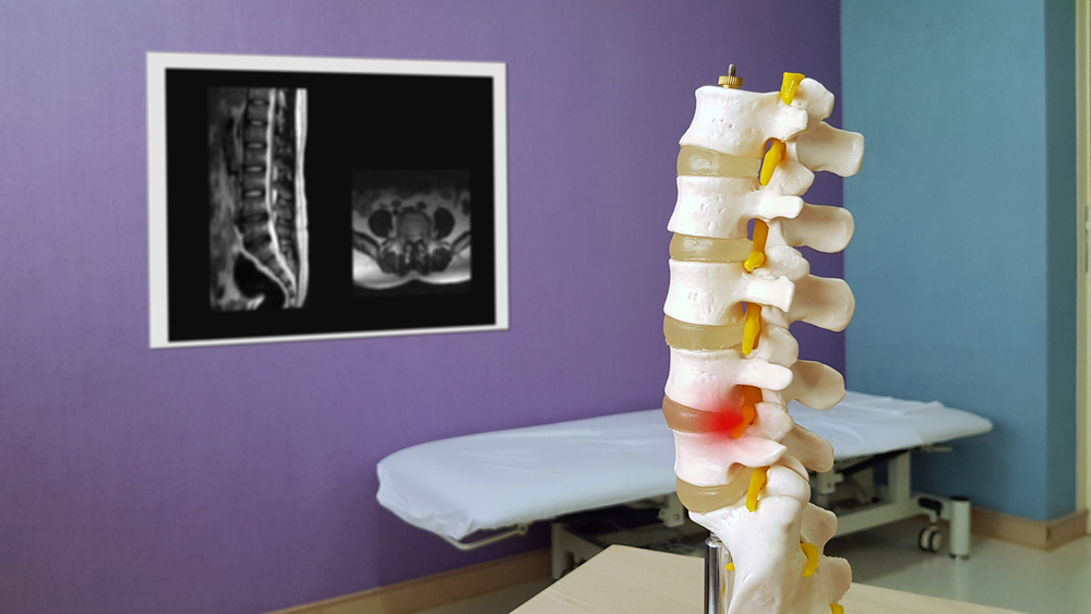 things to avoid if you have spinal stenosis