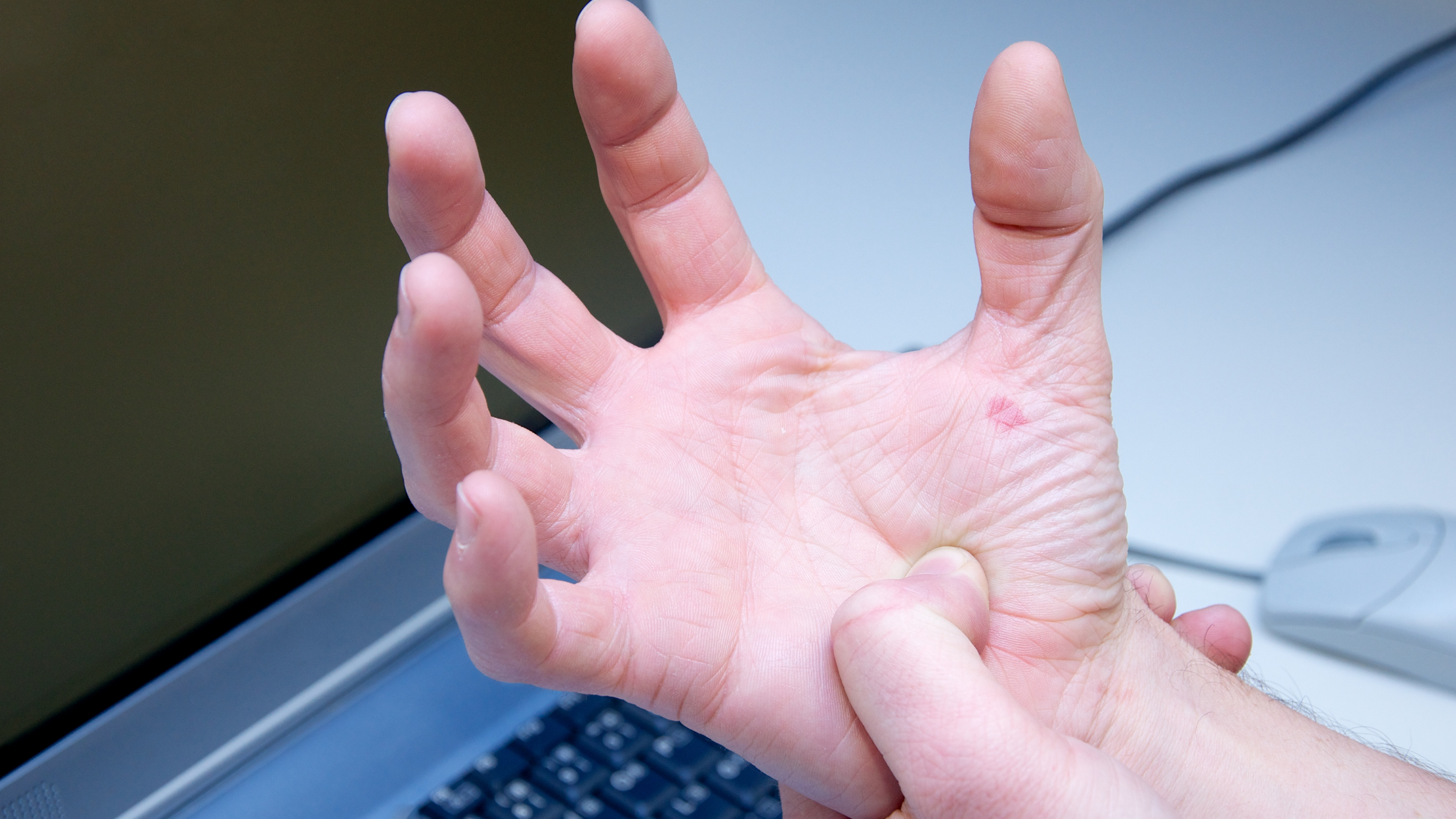 hand with CRPS