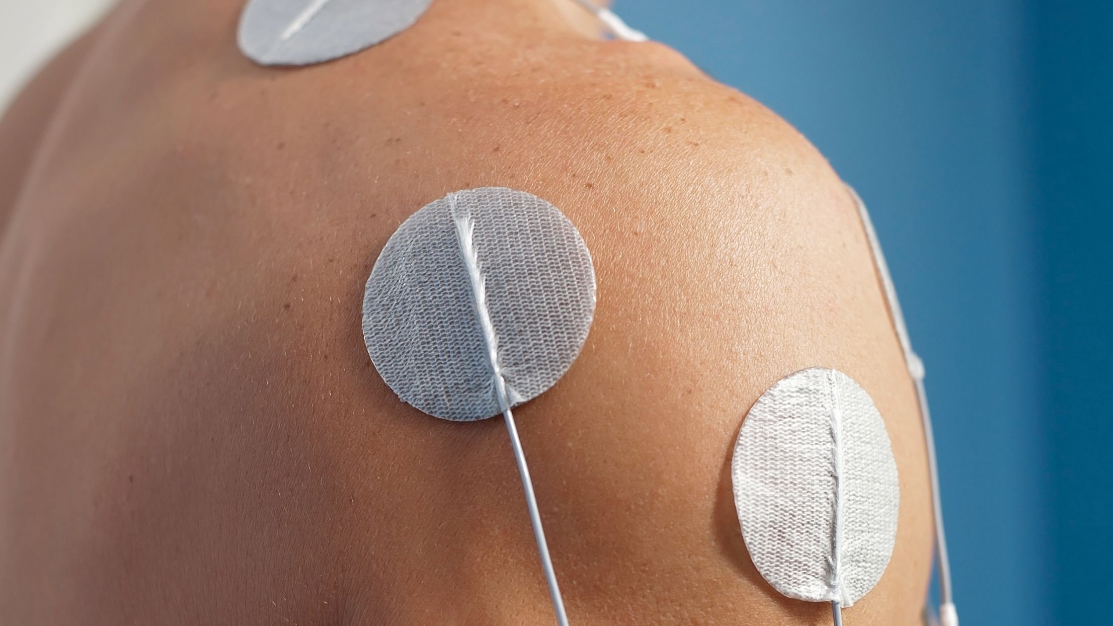 TENS treatments for neuropathic pain