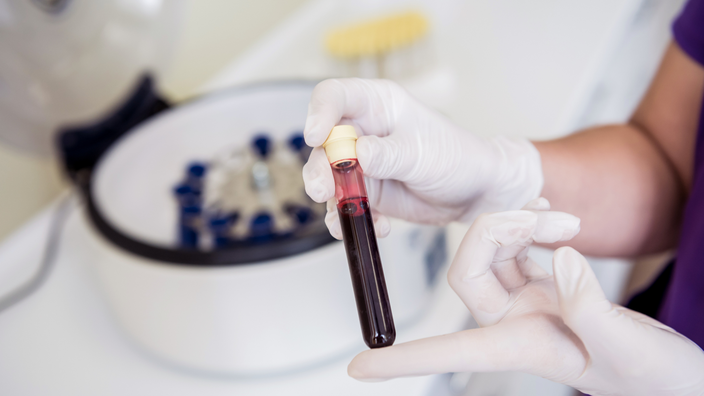 platelet-rich plasma vial in centrifuge machine