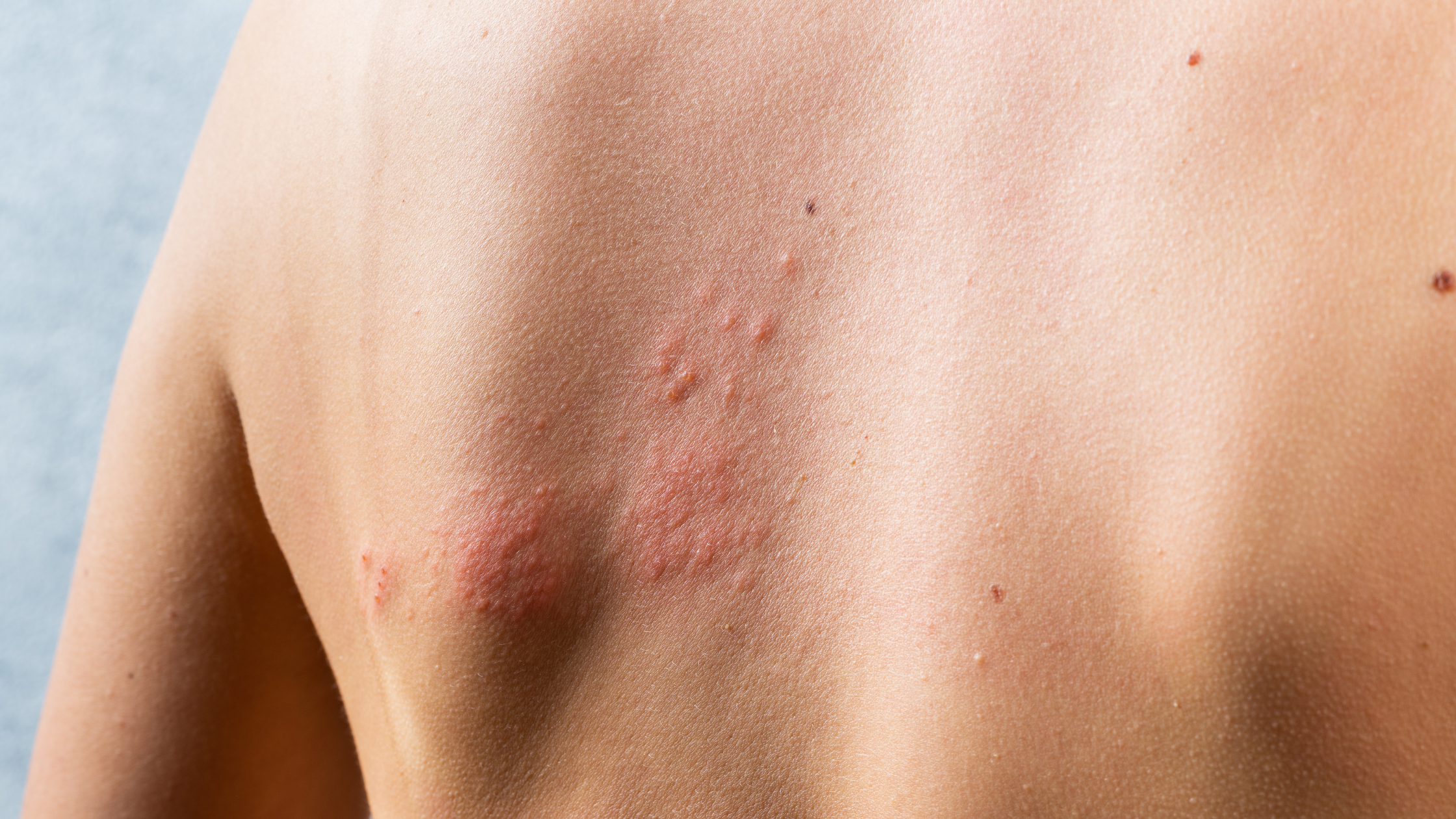 treatment for shingles rash on back