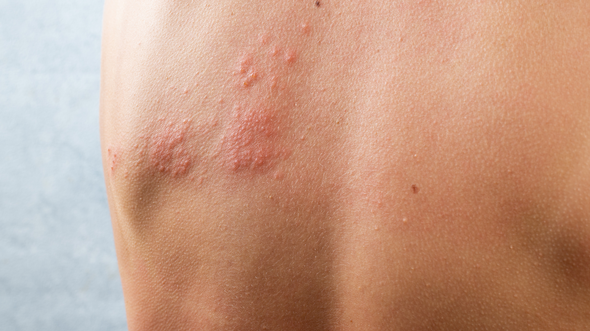 shingles pain relief